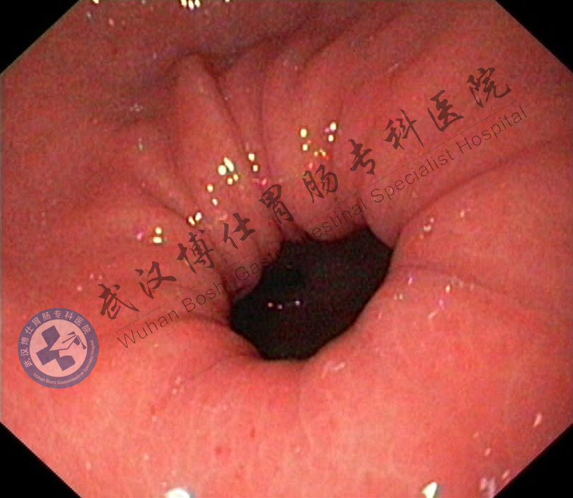 胃窦