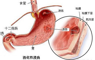 十二指肠球部溃疡的症状及治疗