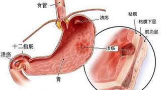 慢性浅表性胃炎伴糜烂