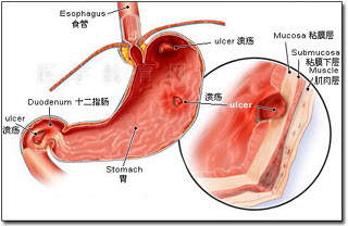 十二指肠球炎的治疗方法