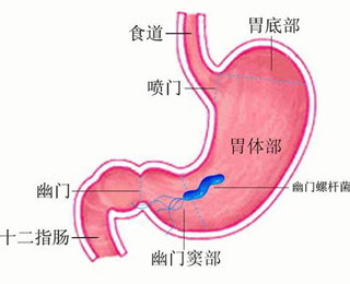 浅表性胃炎伴糜烂严重吗