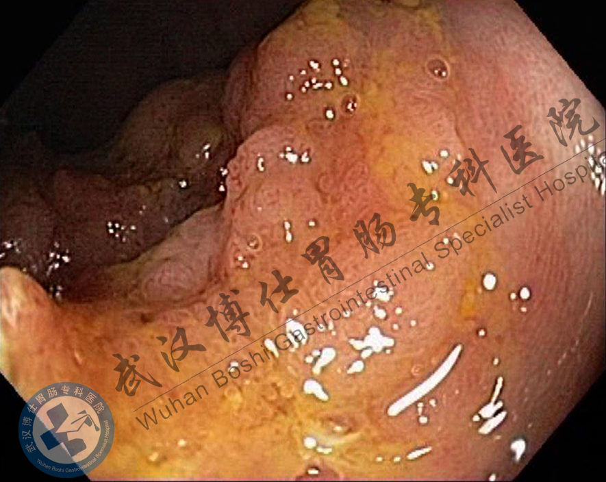 直肠绒毛状腺瘤