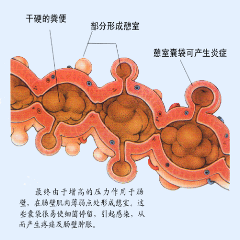 宿便的症状