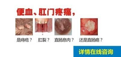 肛门疼痛便血?在线咨询博仕中医医生